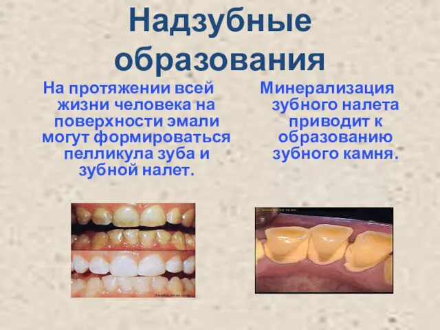 Надзубные образования На протяжении всей жизни человека на поверхности эмали