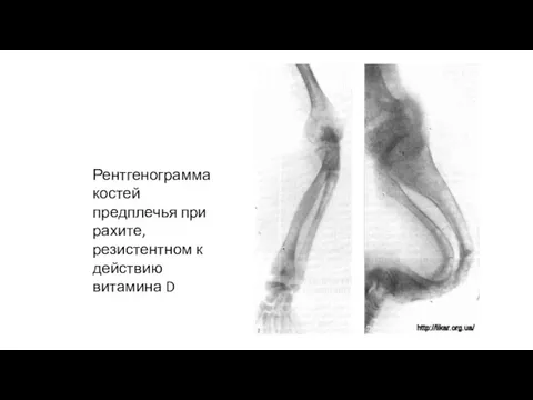 Рентгенограмма костей предплечья при рахите, резистентном к действию витамина D