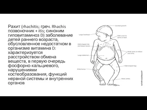 Рахит (rhachitis; греч. Rhachis позвоночник + itis; синоним гиповитаминоз D)