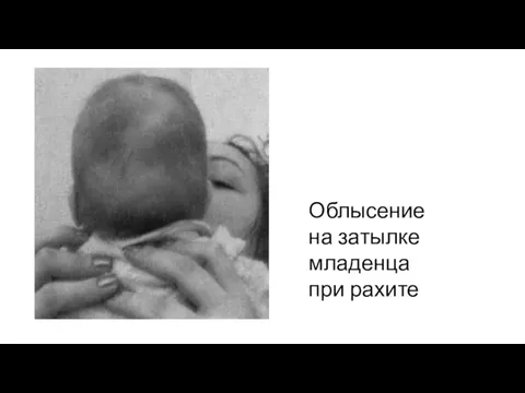 Облысение на затылке младенца при рахите