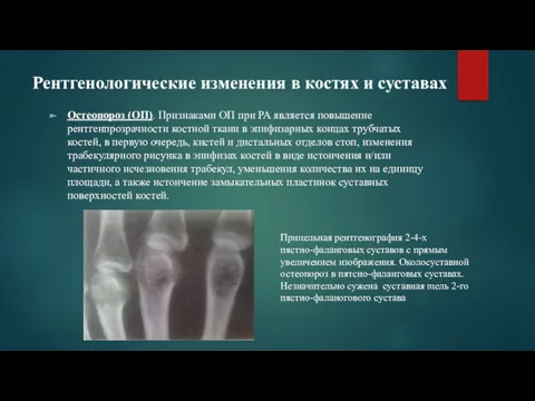 Рентгенологические изменения в костях и суставах Остеопороз (ОП). Признаками ОП