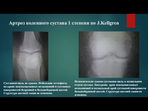 Артроз коленного сустава 1 степени по J.Kellgren Суставная щель не