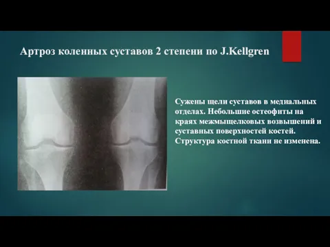 Артроз коленных суставов 2 степени по J.Kellgren Сужены щели суставов