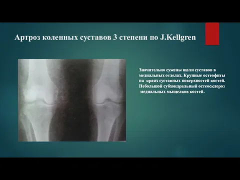 Артроз коленных суставов 3 степени по J.Kellgren Значительно сужены щели