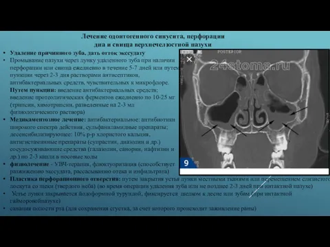 Удаление причинного зуба, дать отток экссудату Промывание пазухи через лунку удаленного зуба при