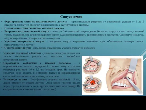 Синусотомия Формирование слизисто-надкостничного лоскута - горизонтальным разрезом по переходной складке от 1 до