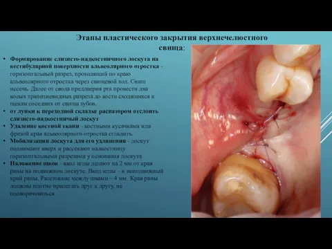 Формирование слизисто-надкостничного лоскута на вестибулярной поверхности альвеолярного отростка - горизонтальный разрез, проходящий по