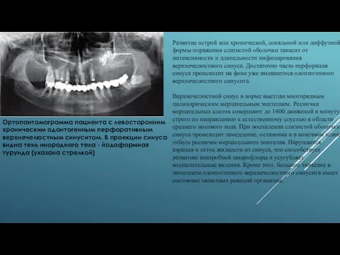 Ортопантомограмма пациента с левосторонним хроническим одонтогенным перфоративным верхнечелюстным синуситом. В проекции синуса видна