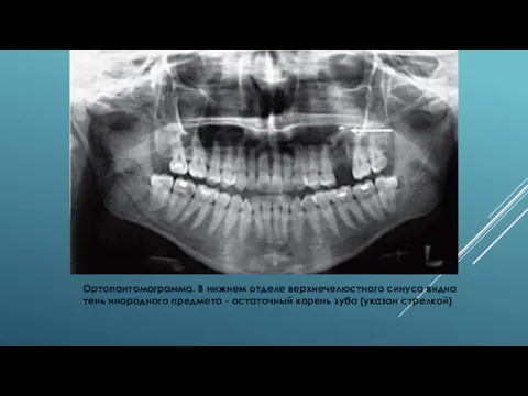 Ортопантомограмма. В нижнем отделе верхнечелюстного синуса видна тень инородного предмета - остаточный корень зуба (указан стрелкой)