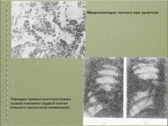 Микропрепарат легкого при орнитозе Передние прямые рентгенограммы правой половины грудной клетки больного орнитозной пневмонией: