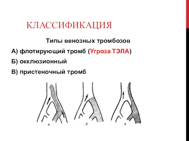 КЛАССИФИКАЦИЯ Типы венозных тромбозов А) флотирующий тромб (Угроза ТЭЛА) Б) окклюзионный В) пристеночный тромб