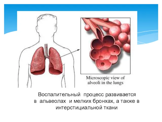 Воспалительный процесс развивается в альвеолах и мелких бронхах, а также в интерстициальной ткани