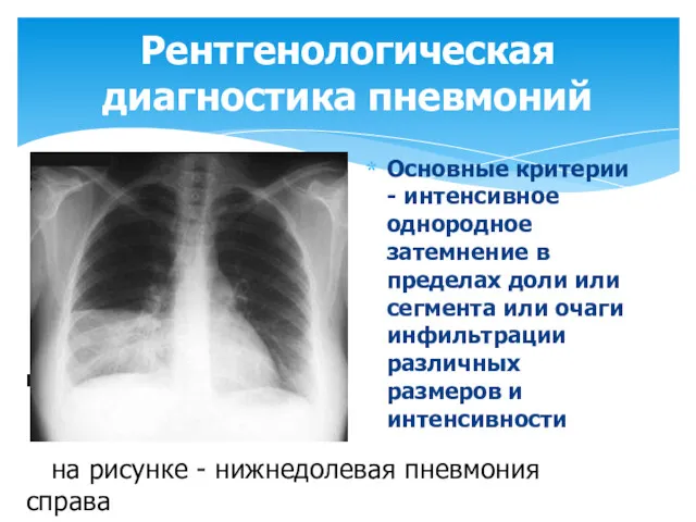 Рентгенологическая диагностика пневмоний Основные критерии - интенсивное однородное затемнение в