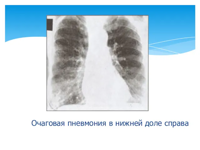 Очаговая пневмония в нижней доле справа