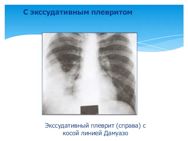 С экссудативным плевритом Экссудативный плеврит (справа) с косой линией Дамуазо