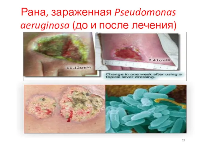 Рана, зараженная Pseudomonas aeruginosa (до и после лечения)