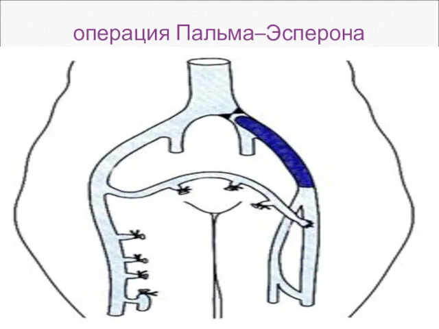 операция Пальма–Эсперона