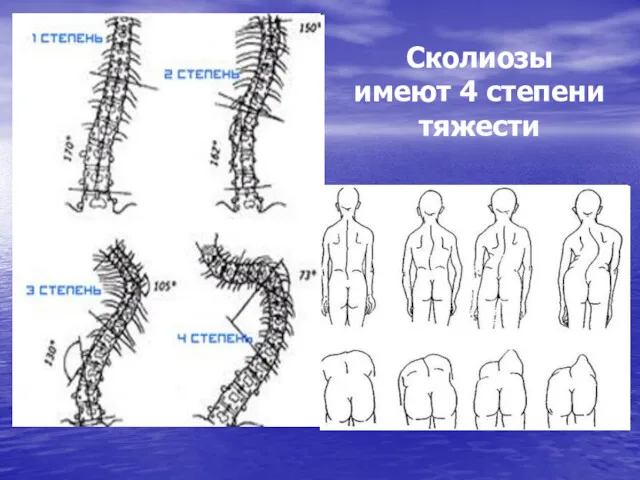 Сколиозы имеют 4 степени тяжести