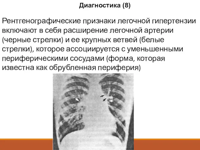 Рентгенографические признаки легочной гипертензии включают в себя расширение легочной артерии (черные стрелки) и
