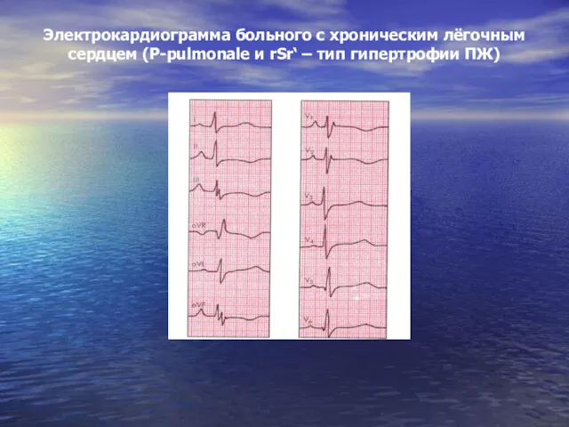 Электрокардиограмма больного с хроническим лёгочным сердцем (Р-pulmonale и rSr‘ – тип гипертрофии ПЖ)
