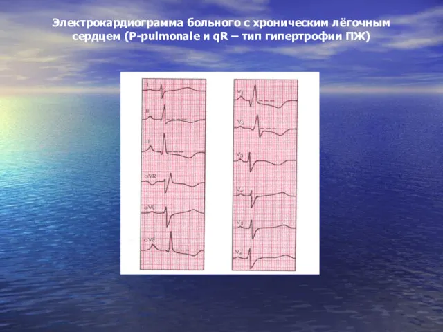 Электрокардиограмма больного с хроническим лёгочным сердцем (Р-pulmonale и qR – тип гипертрофии ПЖ)