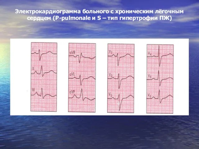 Электрокардиограмма больного с хроническим лёгочным сердцем (Р-pulmonale и S – тип гипертрофии ПЖ)