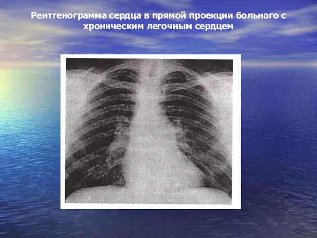 Рентгенограмма сердца в прямой проекции больного с хроническим легочным сердцем