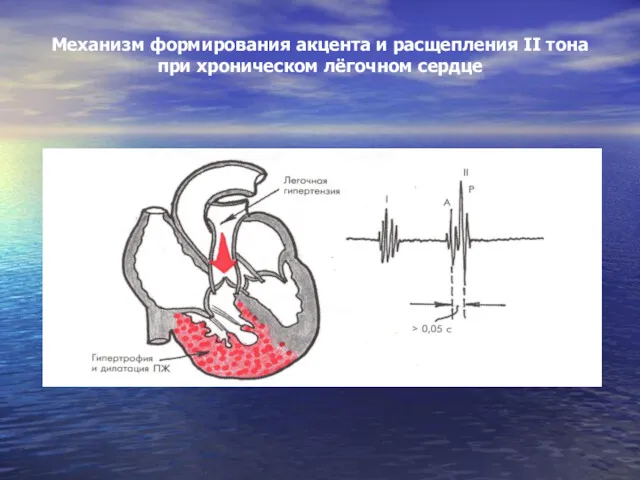 Механизм формирования акцента и расщепления II тона при хроническом лёгочном сердце
