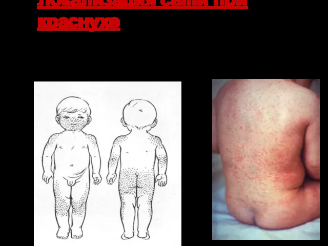 Локализация сыпи при краснухе Сыпь имеет вид ярко-розовых пятен, не сливающихся друг с