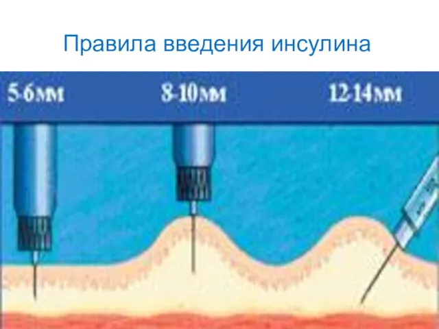 Правила введения инсулина