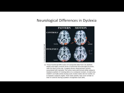Neurological Differences in Dyslexia