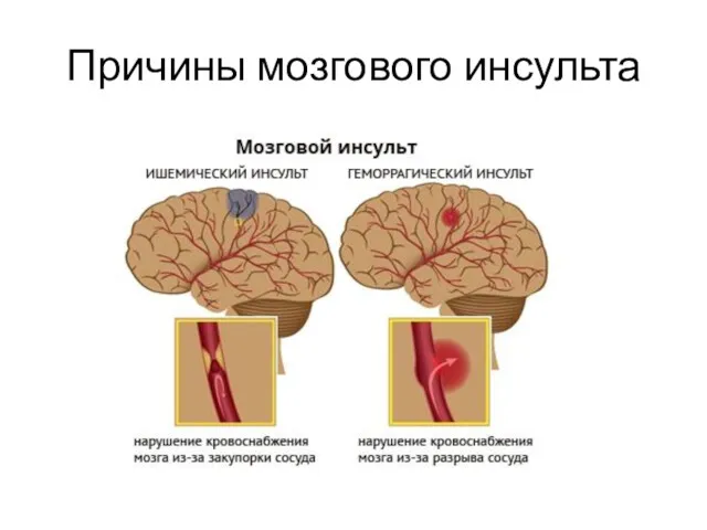 Причины мозгового инсульта