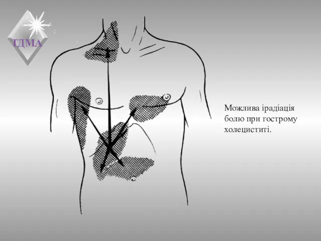 Можлива ірадіація болю при гострому холециститі.