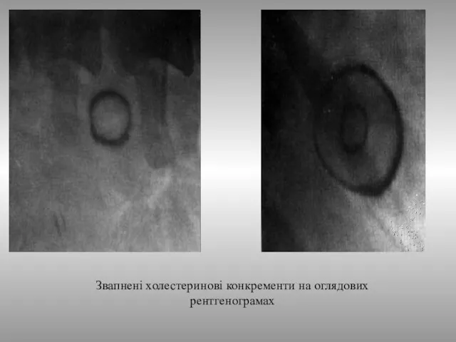 Звапнені холестеринові конкременти на оглядових рентгенограмах