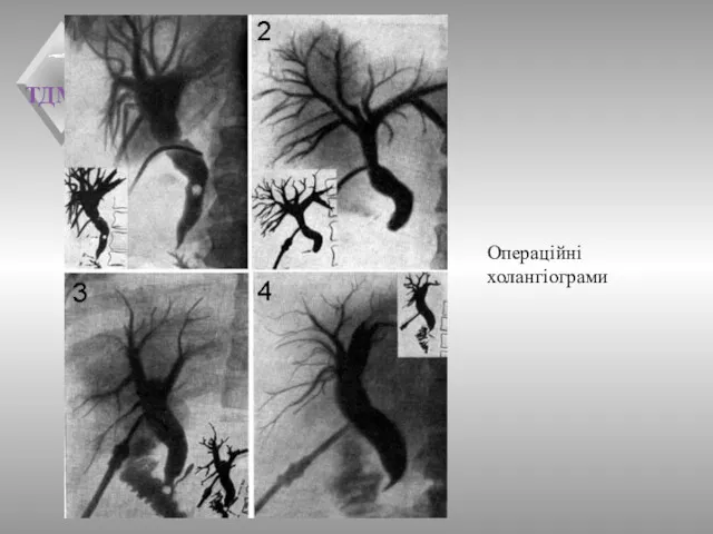 Операційні холангіограми