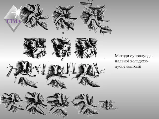 Методи супрадуоде-нальної холедохо-дуоденостомії