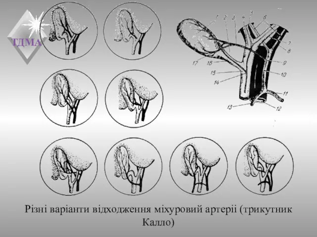 Різні варіанти відходження міхуровий артеріі (трикутник Калло)