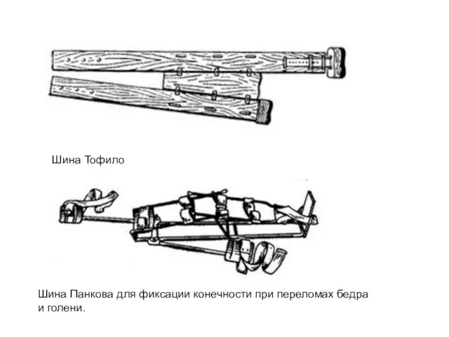 Шина Тофило Шина Панкова для фиксации конечности при переломах бедра и голени.