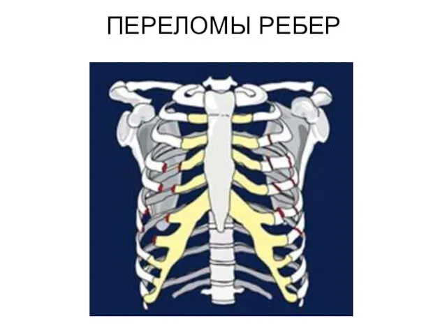 ПЕРЕЛОМЫ РЕБЕР