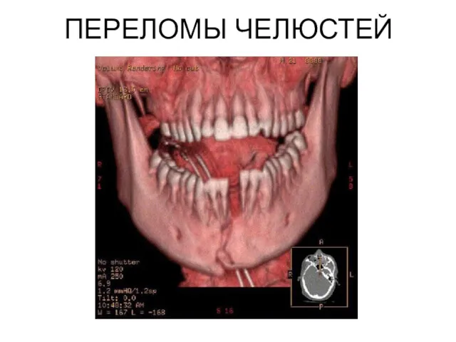 ПЕРЕЛОМЫ ЧЕЛЮСТЕЙ