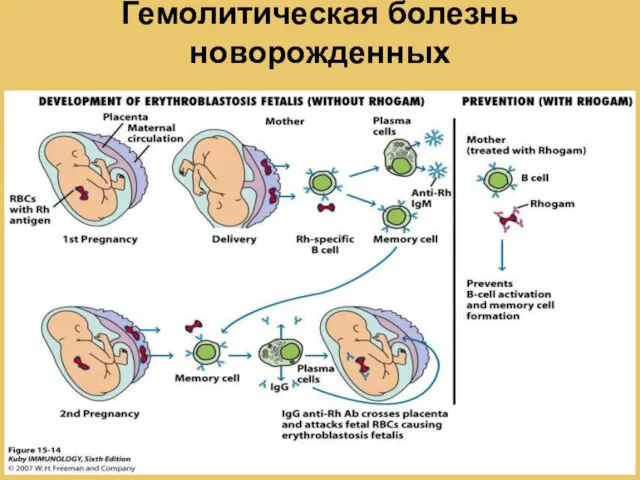 Гемолитическая болезнь новорожденных