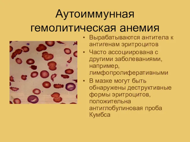 Аутоиммунная гемолитическая анемия Вырабатываются антитела к антигенам эритроцитов Часто ассоциирована с другими заболеваниями,