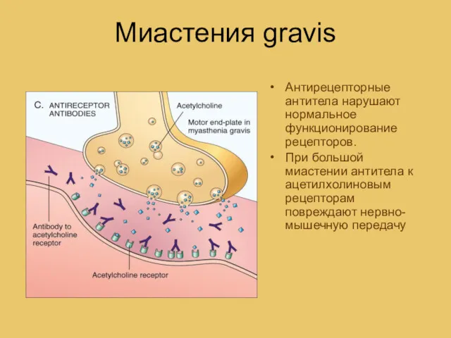 Миастения gravis Антирецепторные антитела нарушают нормальное функционирование рецепторов. При большой