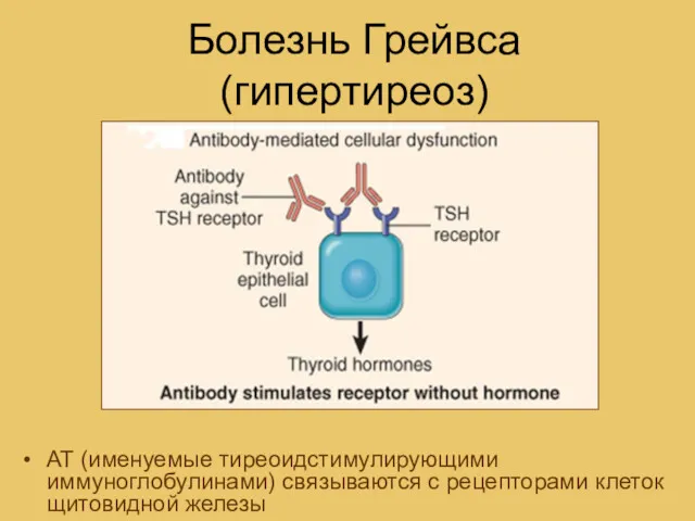 Болезнь Грейвса (гипертиреоз) АТ (именуемые тиреоидстимулирующими иммуноглобулинами) связываются с рецепторами клеток щитовидной железы