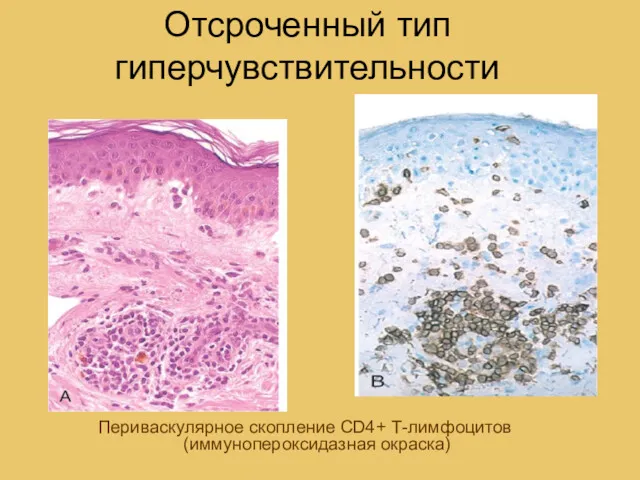 Отсроченный тип гиперчувствительности Периваскулярное скопление CD4+ Т-лимфоцитов (иммунопероксидазная окраска)