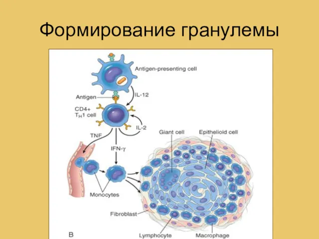 Формирование гранулемы