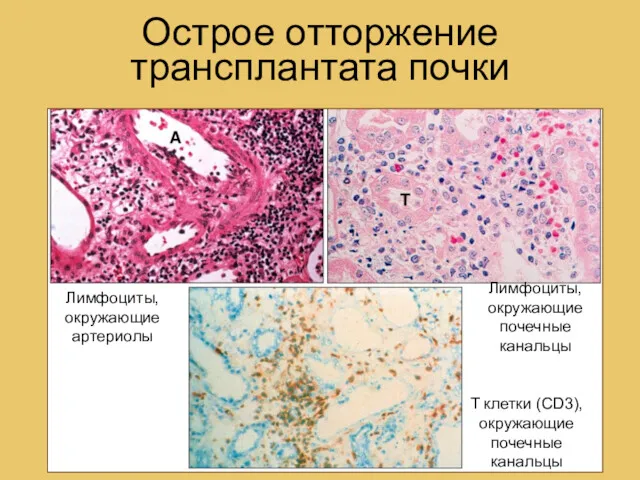 Острое отторжение трансплантата почки T клетки (CD3), окружающие почечные канальцы Лимфоциты, окружающие почечные