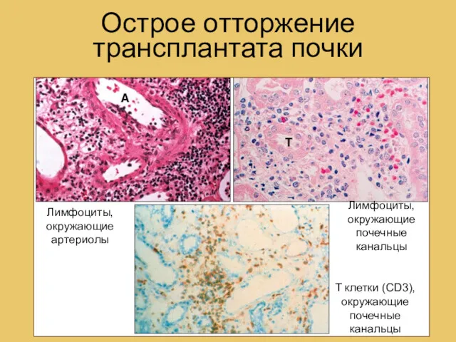 Острое отторжение трансплантата почки T клетки (CD3), окружающие почечные канальцы