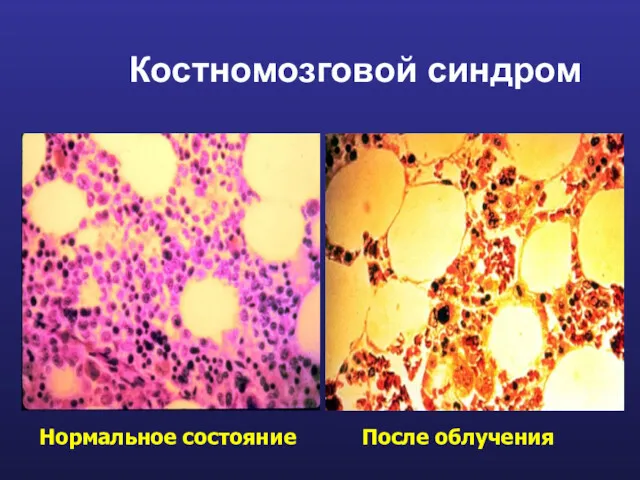 Костномозговой синдром Нормальное состояние После облучения