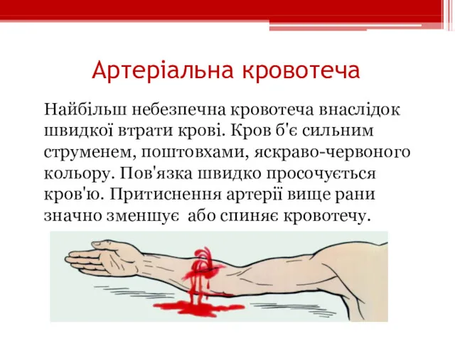 Артеріальна кровотеча Найбільш небезпечна кровотеча внаслідок швидкої втрати крові. Кров б'є сильним струменем,